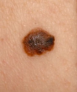 melanoma 6unspecified